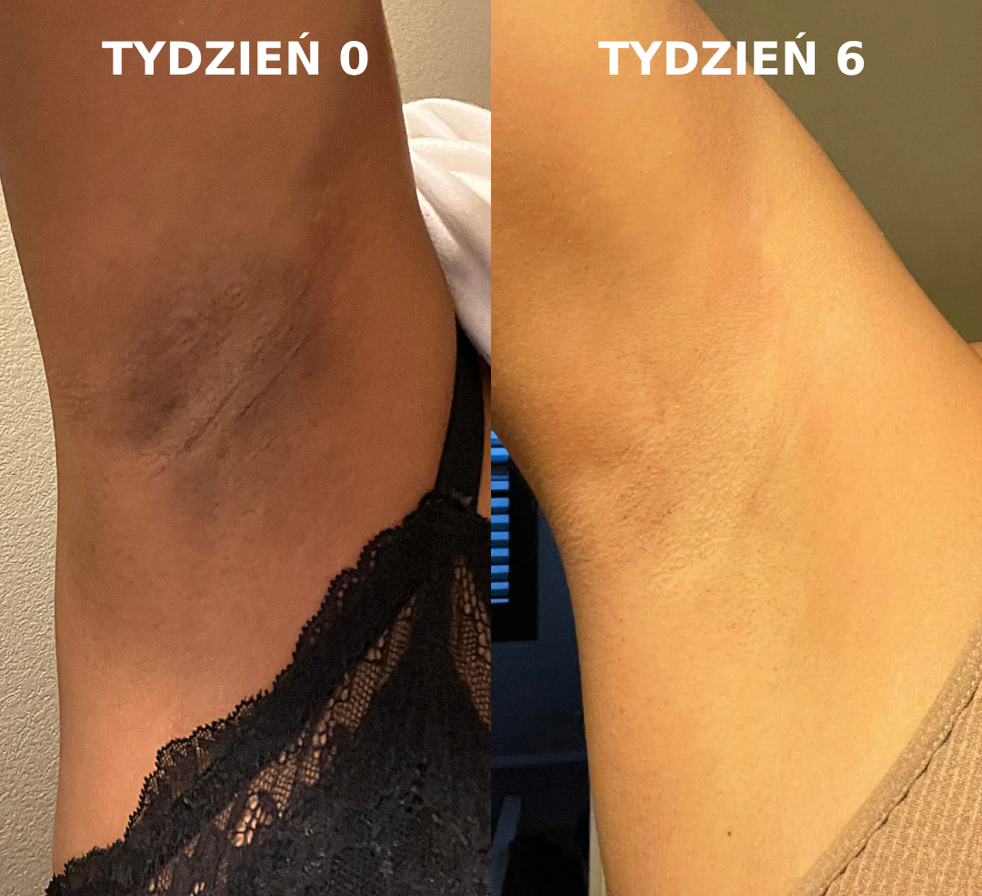ciemne plamy pod pachami leczenie