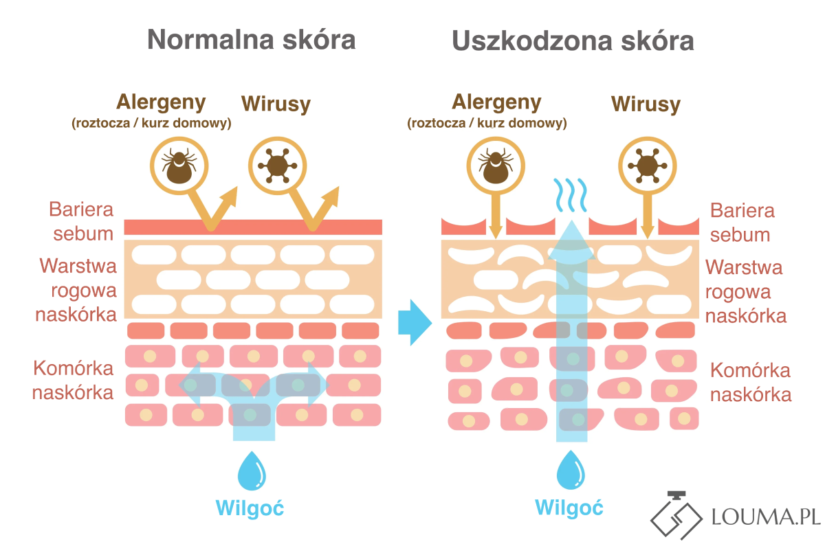 Uszkodzona bariera hydrolipidowa