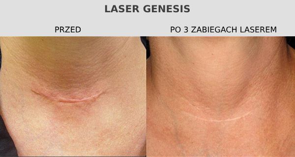 efekty laser genesis