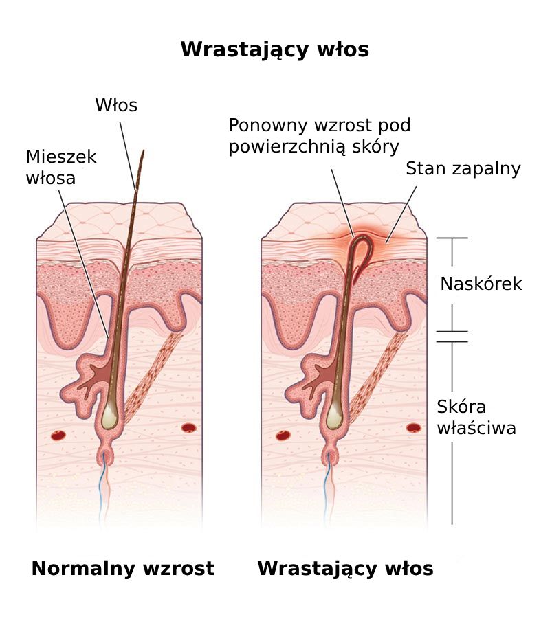 wrastające włoski