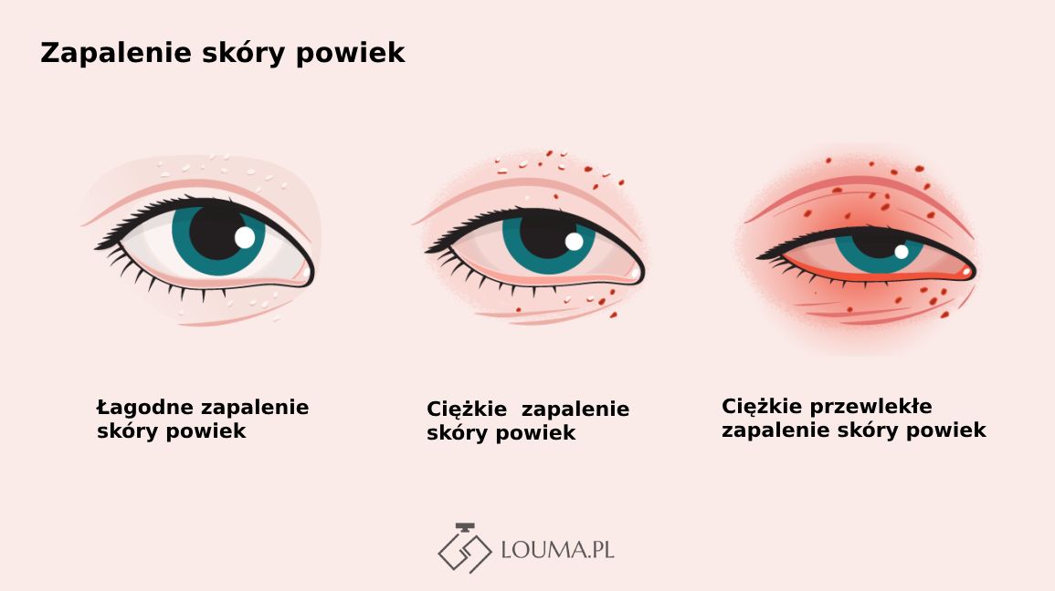 zapalenie skóry powiek