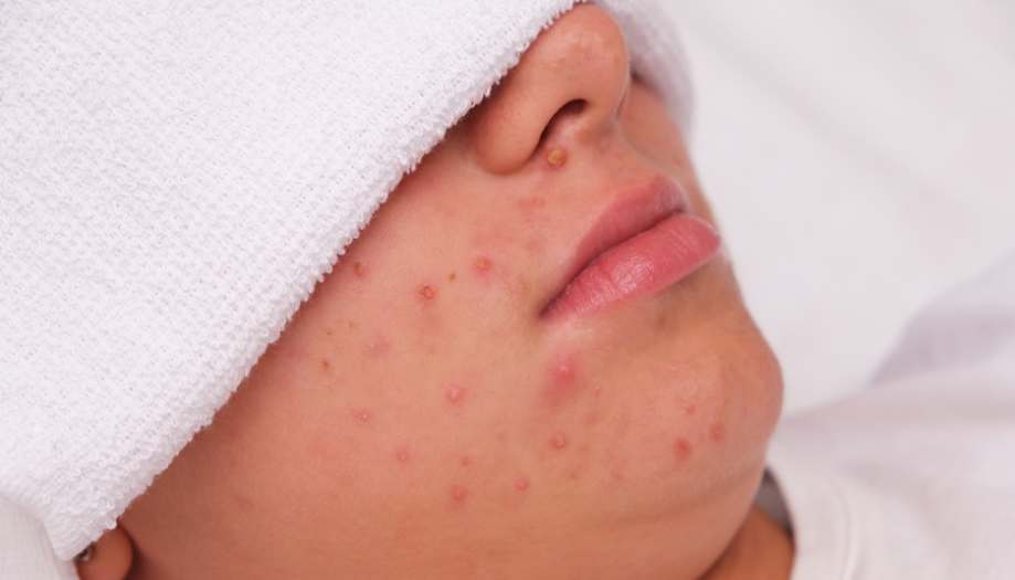 trądzik podskórny